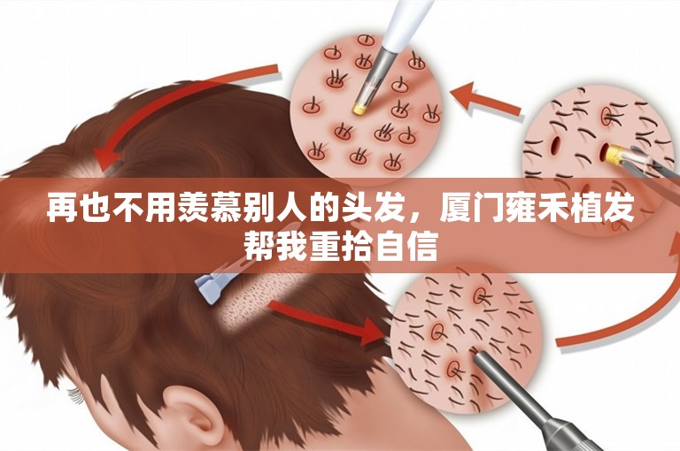 再也不用羡慕别人的头发，厦门雍禾植发帮我重拾自信