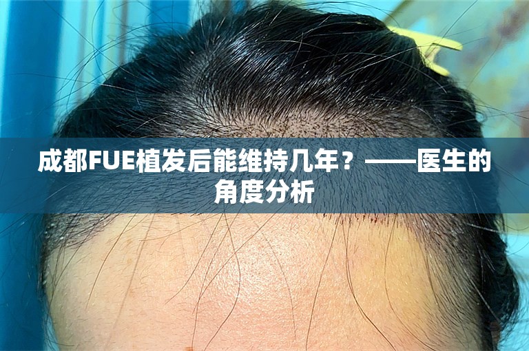 成都FUE植发后能维持几年？——医生的角度分析