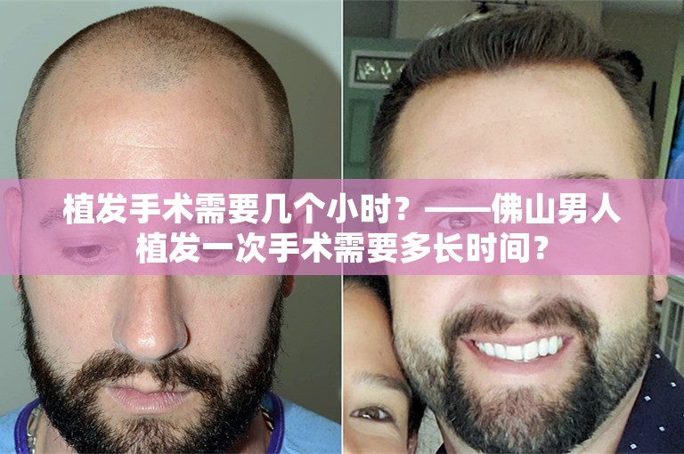 植发手术需要几个小时？——佛山男人植发一次手术需要多长时间？