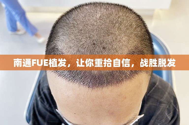 南通FUE植发，让你重拾自信，战胜脱发