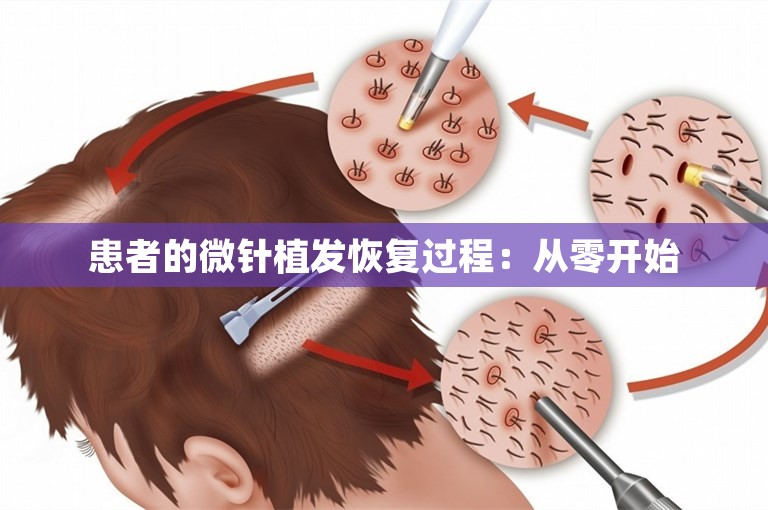 患者的微针植发恢复过程：从零开始