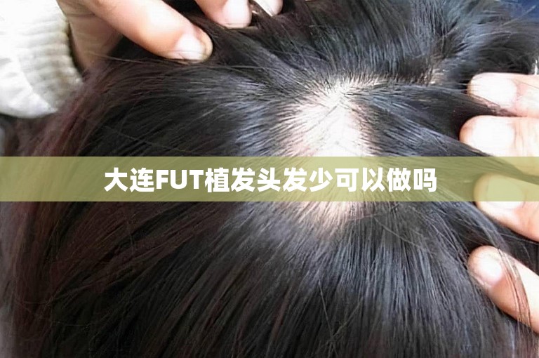 大连FUT植发头发少可以做吗