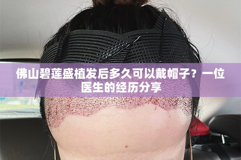 佛山碧莲盛植发后多久可以戴帽子？一位医生的经历分享