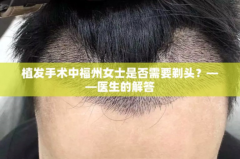 植发手术中福州女士是否需要剃头？——医生的解答