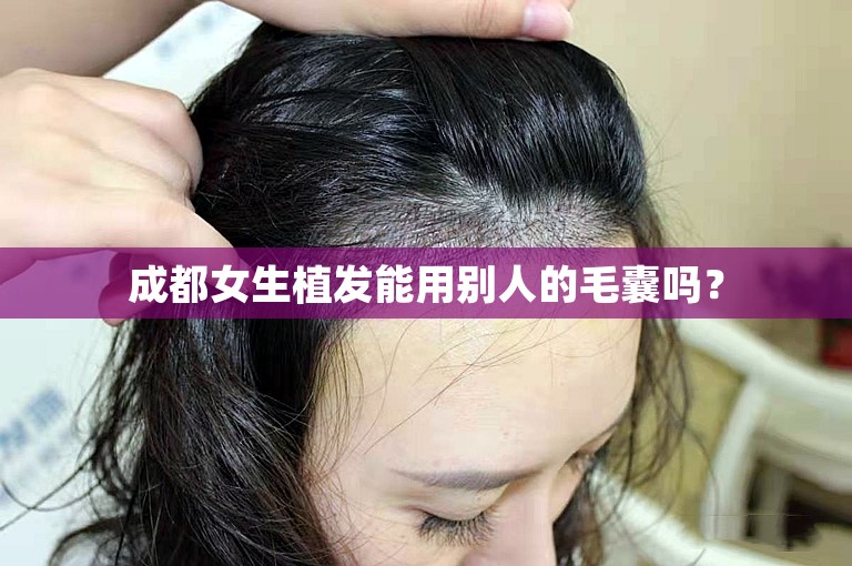 成都女生植发能用别人的毛囊吗？